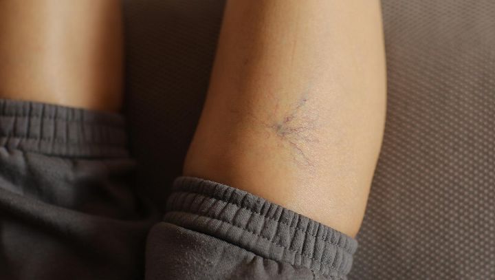 spider-veins-blog-img-OFW-
