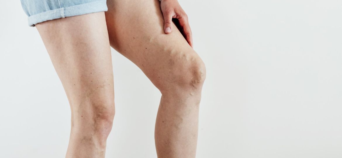 image of varicose veins on woman's legs