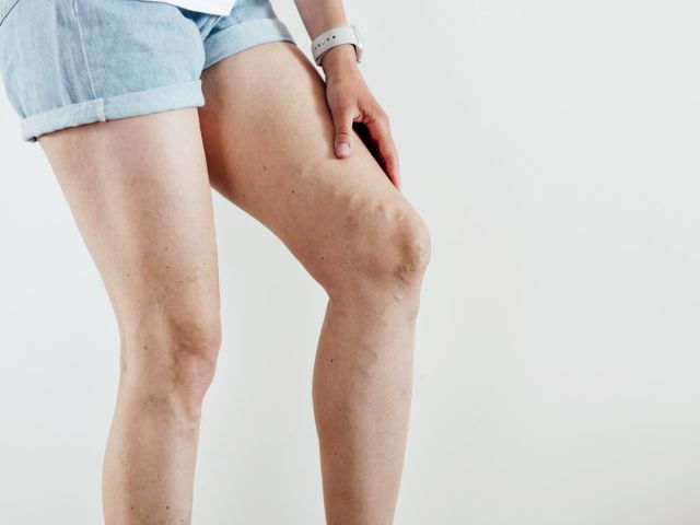 image of varicose veins on woman's legs